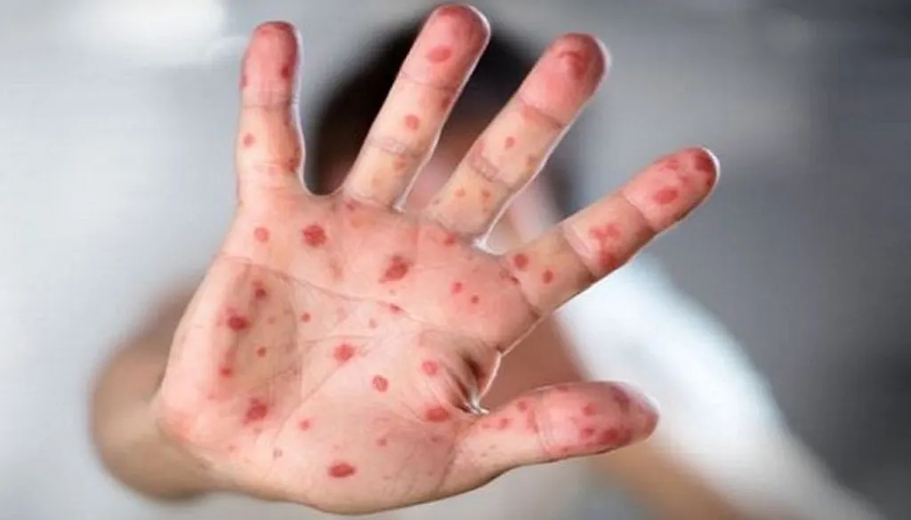 ২৪ ঘন্টায় হামে আরও ৪ শিশুর মৃত্যু