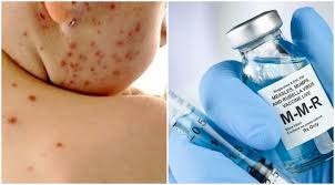 উচ্চঝুঁকিপূর্ণ এলাকায় জরুরি হামের টিকাদান শুরু