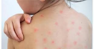 গত ২৪ ঘণ্টায় হামের উপসর্গে আরও ১১ শিশুর মৃত্যু