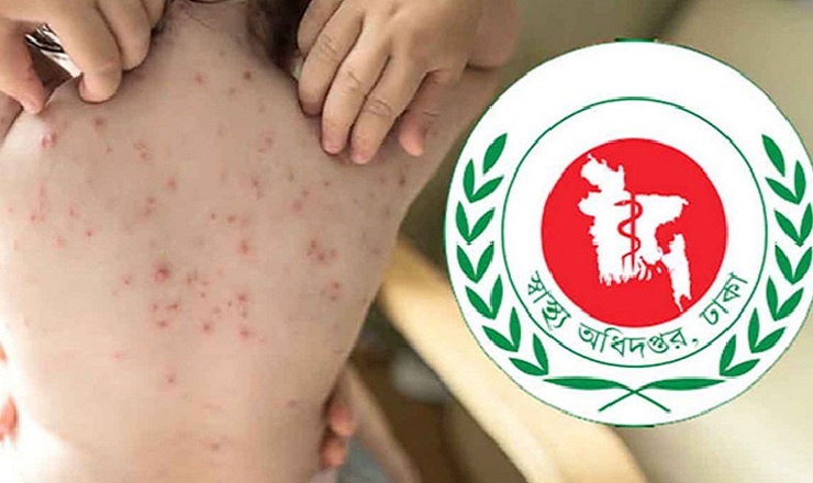 দেশে হামে আরও ৪ শিশুর মৃত্যু